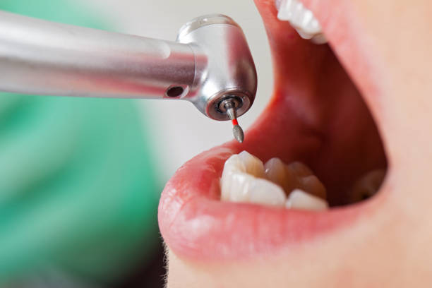 Best Emergency Dentist for Lost Fillings or Crowns in Westhampton Beach, NY